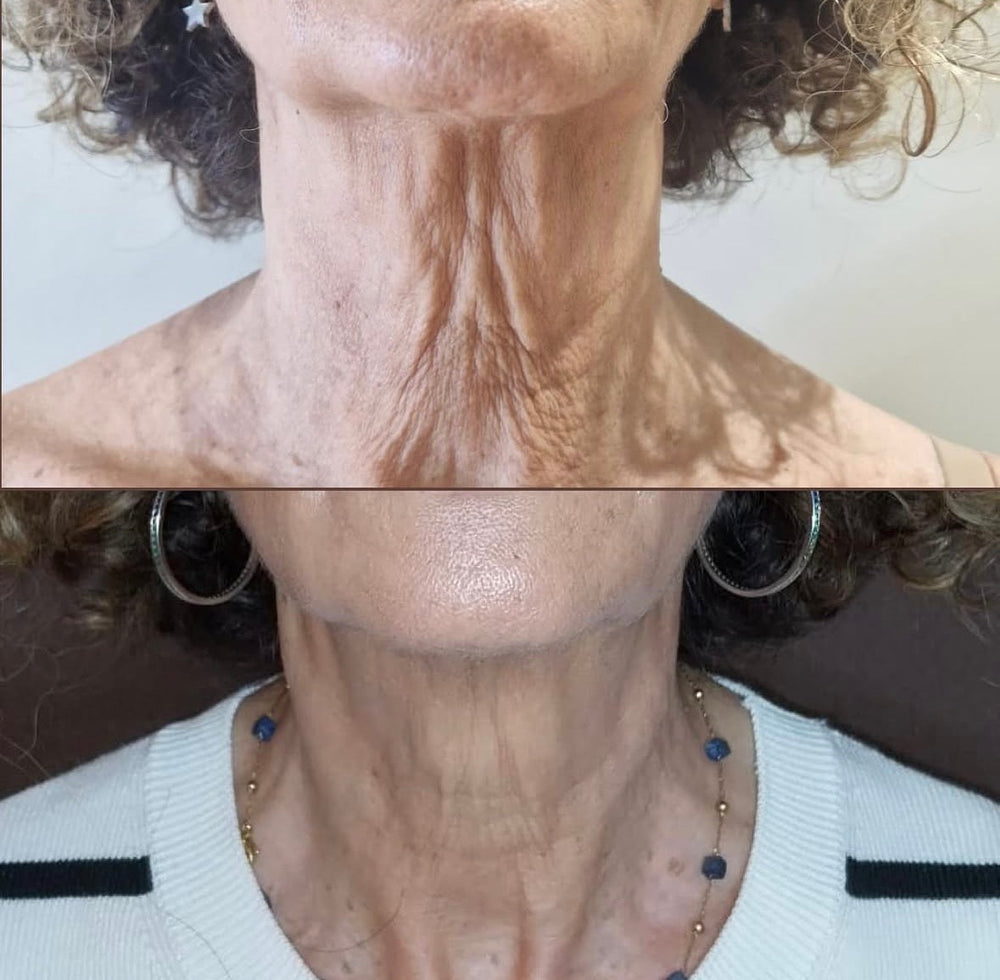 ULTRAFORMER + INDUCTORES DE COLÁGENO